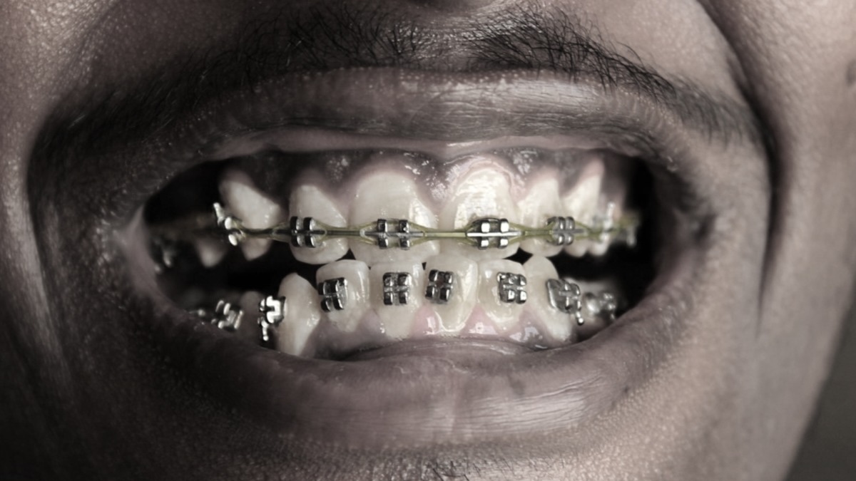 Can You Do MMA With Braces? (Yes, But It'll Be Costly)